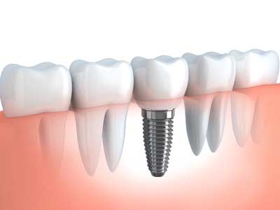 Dental Implant at Dundas West Family and Cosmetict Dentistry, Etobicoke