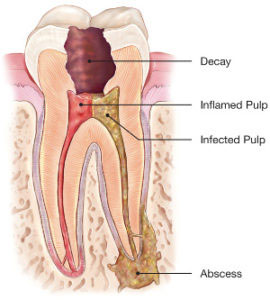 Root Canal Treatment at Dundas West Dentistry in Etobicoke